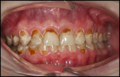 Clinical photograph showing cervical enamel erosion and demineralization