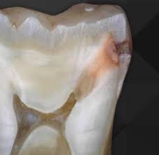 Cross-section of a tooth showing internal enamel and dentin erosion