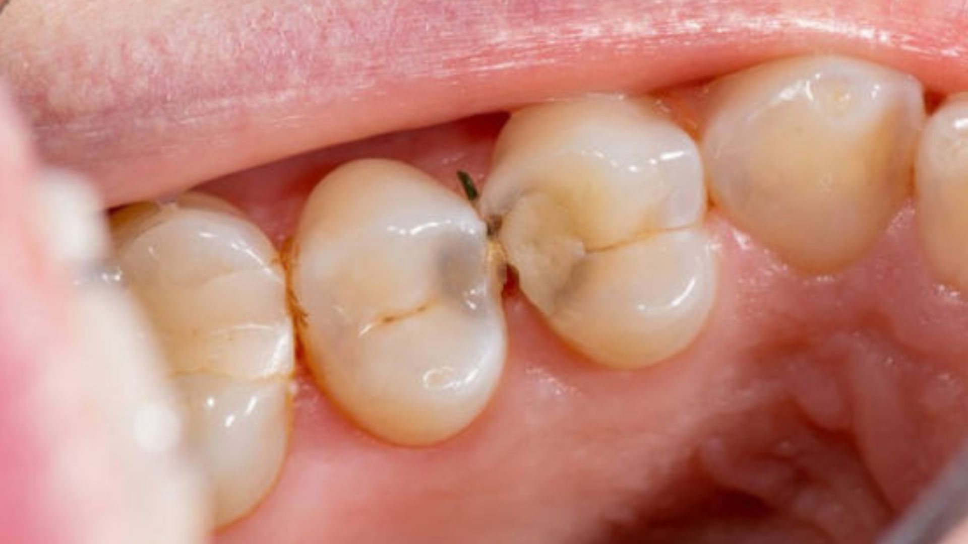 Clinical photograph showing interproximal decay progression between posterior teeth