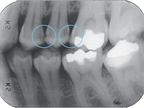 Bitewing radiograph revealing interproximal decay not visible to the naked eye